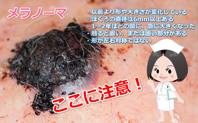 メラノーマ画像